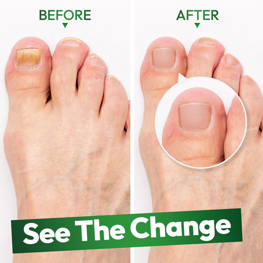 VERDORA Toenail Fungus Treatment Duo