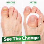 Duo soin des ongles fongiques VERDORA