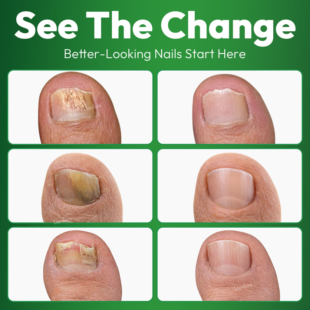 VERDORA FIXLAB Fungal Nail Care Solution